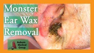 Monster Ear Wax Removal Brings New Life to JOKESTER Patient  Auburn Medical Group [upl. by Keele191]