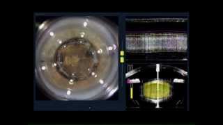 Femto laser Cataract surgery ReStor T LenSx Part 1 Laser treatment [upl. by Einnal]