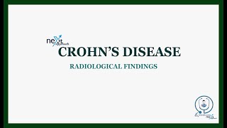 Crohns disease radiology [upl. by Naelcm]