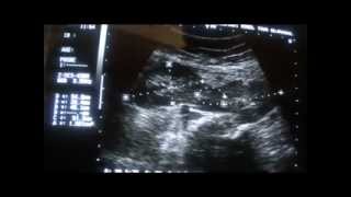 ultrasound of HORSE SHOE SHAPED KIDNEY [upl. by Reede]