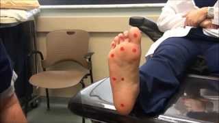 Neurologic Examination of the Foot 10gm Monofilament Test [upl. by Parrott]