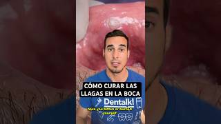 Cómo CURAR las LLAGAS AFTAS o ÚLCERAS en la boca  Quemaduras y mordeduras en el labio y lengua [upl. by Llyrad238]