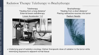 No Beam Required InsideOut Radiotherapy HDR Brachytherapy for Prostate Cancer [upl. by Aimal145]