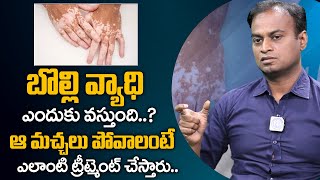 Vitiligo Symptoms Causes Treatment in Telugu  Dr Bharadwaz About Vitiligo  iDream Health [upl. by Assennav]