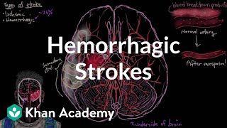 Hemorrhagic strokes  Circulatory System and Disease  NCLEXRN  Khan Academy [upl. by Tammany]