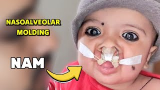 A Mother Shows How To Use Nasoalveolar Molding NAM Device in Cleft Lip Child [upl. by Swanhildas54]