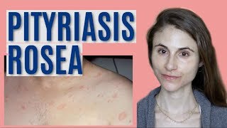 PITYRIASIS ROSEA WHAT IT IS amp GETTING RID OF IT DR DRAY [upl. by Isolde]