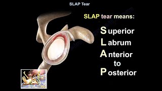 SLAP Tear  Everything You Need To Know  Dr Nabil Ebraheim [upl. by Yerahcaz]