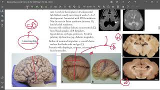 5 Lissencephaly [upl. by Mackey814]