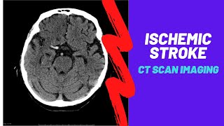 Imaging of Ischemic Stroke For Medical students residents and clinicians [upl. by Matty]