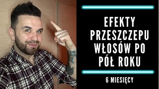 Efekty przeszczepu włosów po pół roku  6 MIESIĘCY PO PRZESZCZEPIE [upl. by Hcra]