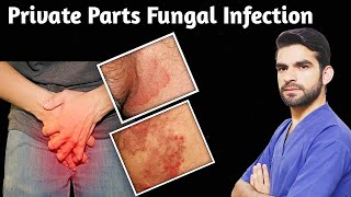 Fungal infection of private parts [upl. by Elleirb]