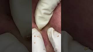 Big Cystic Acne Blackheads Extraction Blackheads amp Milia Whiteheads Removal Pimple Popping shorts [upl. by Yruoc119]