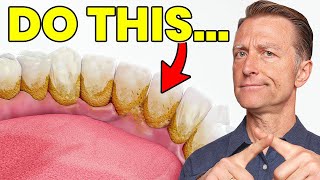 The 1 Top Remedy for Dental Plaque TARTAR [upl. by Natie527]