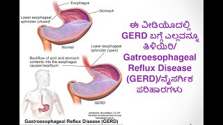 ಈ ವೀಡಿಯೊದಲ್ಲಿ GERD ಬಗ್ಗೆ ಎಲ್ಲವನ್ನೂ ತಿಳಿಯಿರಿGatroesophageal Reflux Disease GERDನೈಸರ್ಗಿಕ ಪರಿಹಾರಗಳು [upl. by Syhr577]