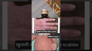 Permethrin Lotion Uses in Hindi।How to apply।Best for Lice and scabies।उपयोग हिंदी में। दाद खाज जूं। [upl. by Alesram77]