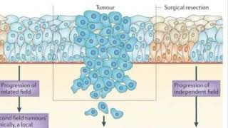 FIELD CANCERIZATION [upl. by Eirffej]