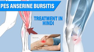 quotपेस ऐंसरीन बरसाइटिस का इलाज  Pes Anserine Bursitis Treatment in Hindiquot [upl. by Rori]