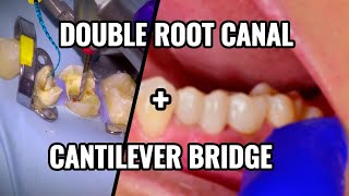 90 Double Root Canal  Cantilever Bridge [upl. by Pearle]