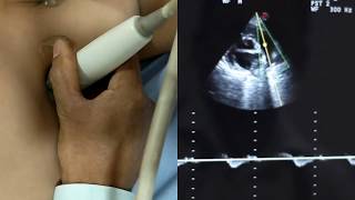 Echocardiogram Learning Part 4 Para Sternal Long Axis and Short Axis View [upl. by Rosina]