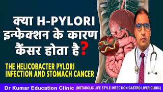 क्या Hpyloriइन्फेक्शन के कारण कैंसर होता हैThe Helicobacter pylori infection and stomach cancer [upl. by Alya]