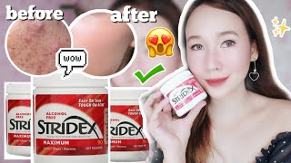 BEST amp EFFECTIVE SALICYCLIC ACID FOR ACNE PRONE SKIN STRIDEX TONER PADS REVIEW PHILIPPINES [upl. by Ahsirak]