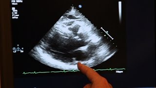 Echocardiogram Demonstration [upl. by Gujral]