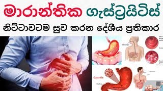 සිංහලෙන්  How to avoid gastritis in Sinhala   The Life Acer [upl. by Giddings]