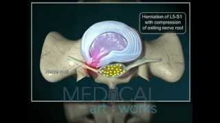 3D Medical Animation  L5S1paracentraldischerniation with compression of nerve root [upl. by Noyerb]