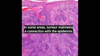 Histopathology of Porocarcinoma dermatopathology dermpath shorts [upl. by Kalina326]