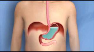 Heartburn Acid Reflux GERDMayo Clinic [upl. by Saoj]