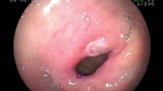 pyloric Channel Ulcer [upl. by Sidonie]