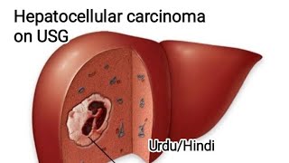 Liver mass on ultrasound Abdominal Ultrasound Hepatic focal lesion on ultrasound [upl. by Melton]