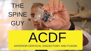 CERVICAL STENOSIS RADICULOPATHY  PART 5  ACDF [upl. by Maibach404]