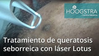 Tratamiento de queratosis seborreica con láser Lotus 18094 [upl. by Atthia792]