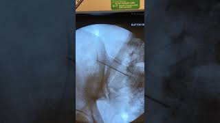 SacroIliac Joint Injection [upl. by Jolee]