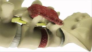 Transforaminal Lumbar Interbody Fusion TLIF  DePuy Videos [upl. by Lebaron310]