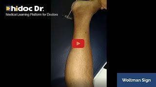 Woltman Sign Video  Medical Cases Video only on Hidoc [upl. by Anolahs]