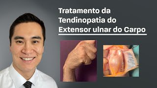 Tratamento da Tendinopatia do Extensor Ulnar do Carpo [upl. by Ralaigh]