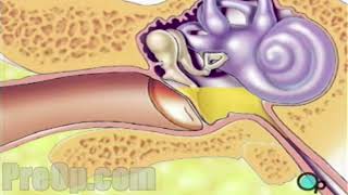 Myringotomy Insertion of Tube Surgery PreOp® Patient Education [upl. by Nye]