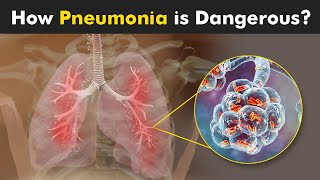 What Happens in Pneumonia  Symptoms Causes and Treatment 3D Animattion [upl. by Ainirtac925]