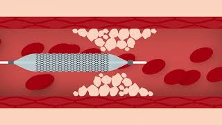 Heart Stent Procedure [upl. by Tessie393]