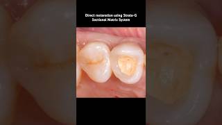 Direct Restoration using StrataG Sectional Matrix System [upl. by Felipe]