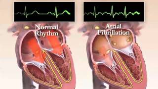 What is Atrial Fibrillation Chapter 1 HRS Patient Video [upl. by Inan]