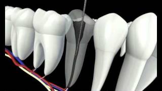 Root Canal Procedure 3D Animation  Endodontics Los Angeles [upl. by Lux]