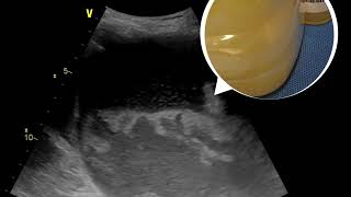 How empyema thoracic or lung abscess can be seen from bedside ultrasound [upl. by Ludeman]