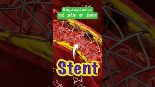 Angioplasty angioplasty heartattack facts ytshortsindia science [upl. by Mathias]