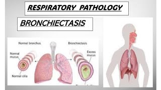 Respo pathology  COPD  BRONCHIECTASIS copd bronchiectasis pathology [upl. by Anasiul189]