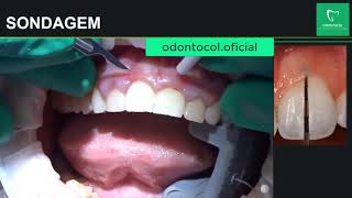 Periodontia Sondagem Passo a Passo E Aumento de coroa clínica Aula 04 [upl. by Eseenaj]