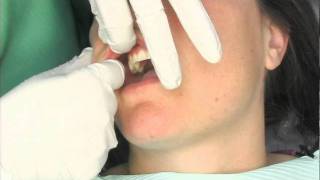 Oral Cancer Screening Exam [upl. by Garnet361]